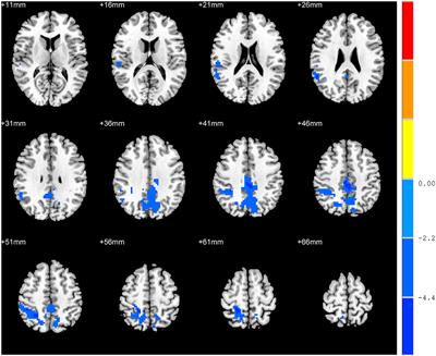 The Association Between Precuneus Function and Residual Dizziness in Patients With Benign Paroxysmal Positional Vertigo